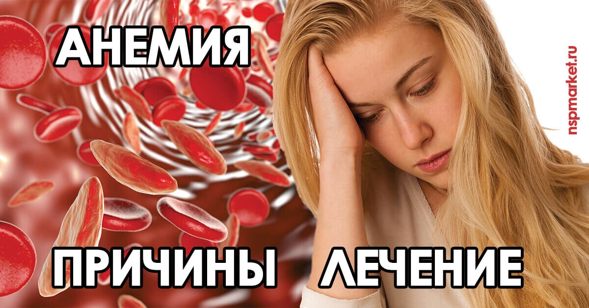 Причины анемии, дефицитная анемия. Анемия крови - лечение у детей и взрослых