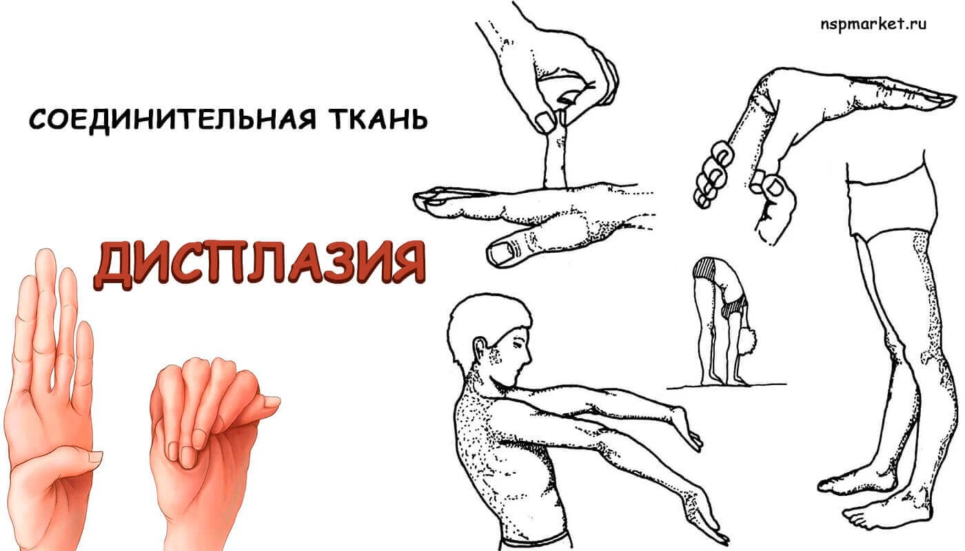 Дисплазия. Заболевания соединительной ткани человека