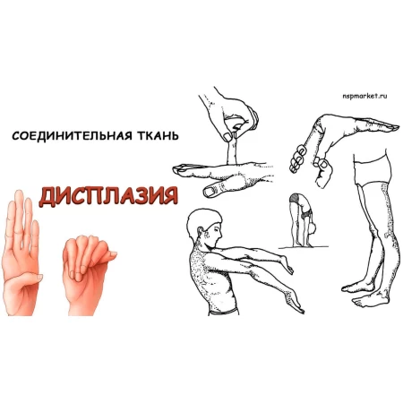 Дисплазия соединительной ткани